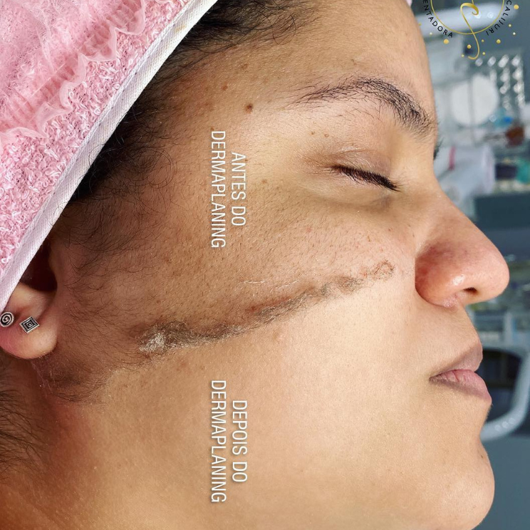 dermaplaning 27