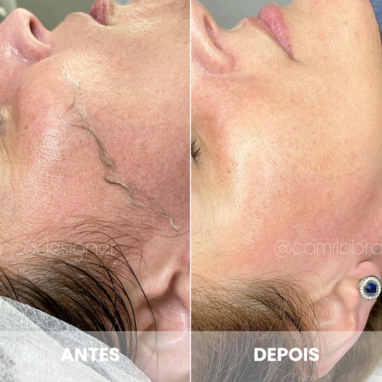 dermaplaning 30