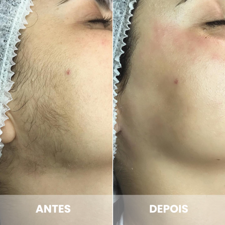 Para que serve o Dermaplaning? Especialista explica tudo