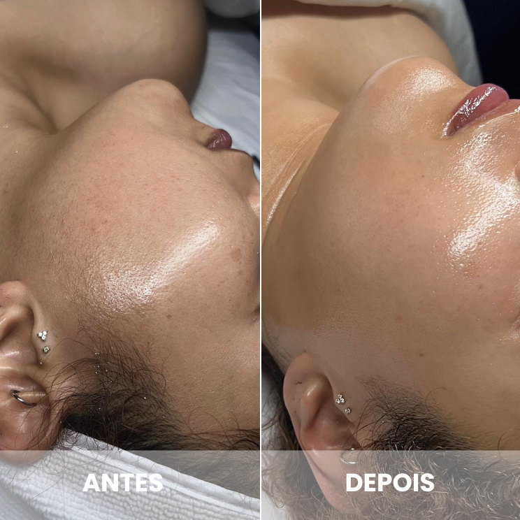 dermaplaning 25